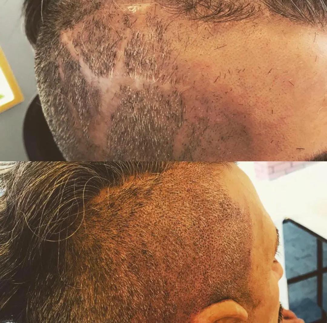 Yara izi kapatma SMP uygulaması öncesi ve sonrası